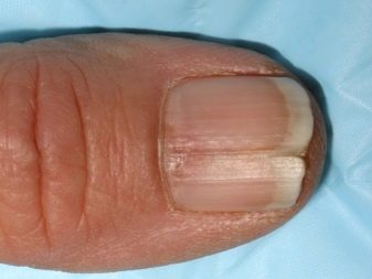 Allergy to gel polish (32 photos): symptoms and causes, list of ...
