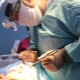 Procedūros endoskopinis veido atvaizdavimas